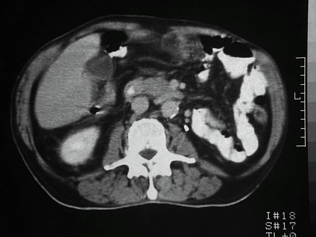 an abdominal CT image