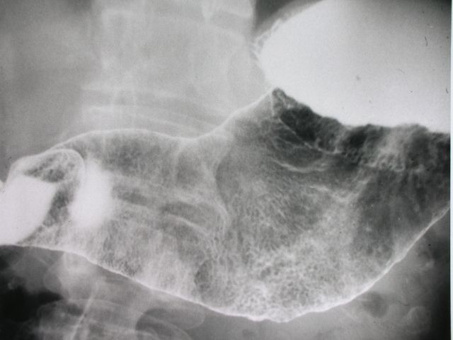 an air contrast barium meal or upper GIT image