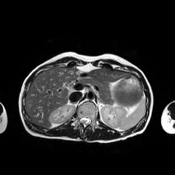 an MRI abdominal image