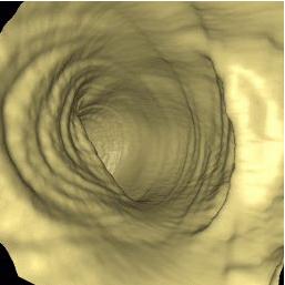 a virtual colonoscopy endoluminal view'